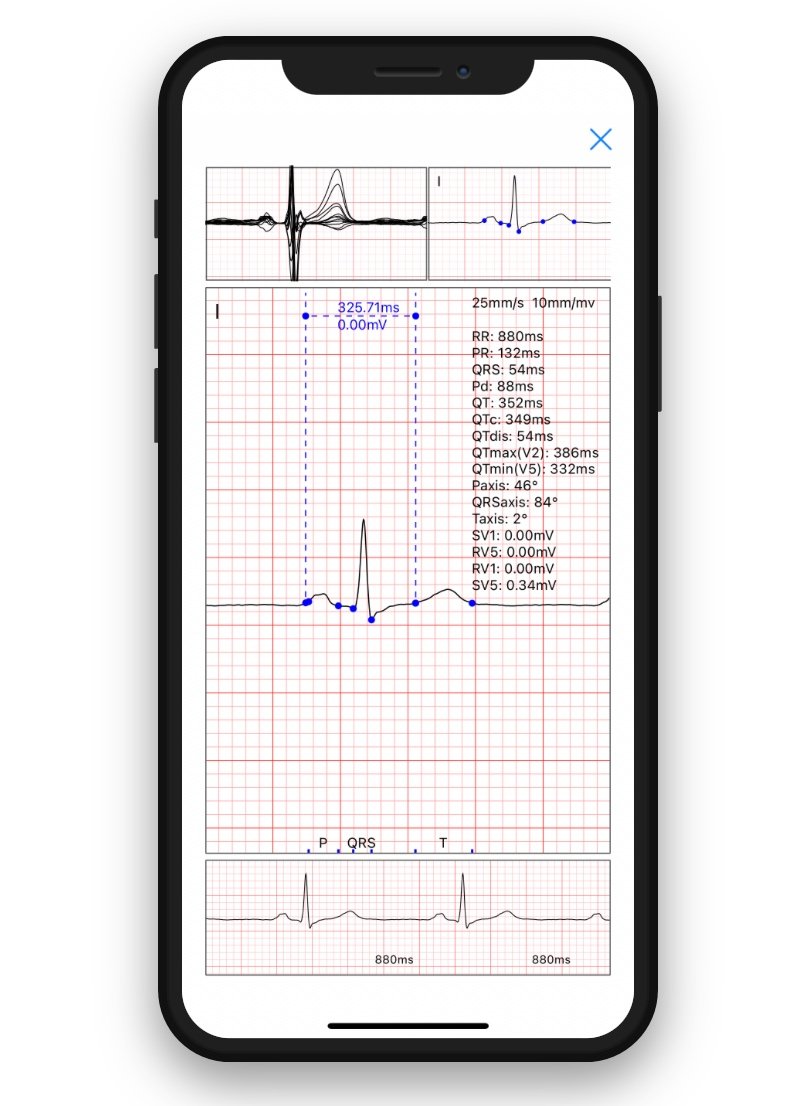 VH ECG on Phone