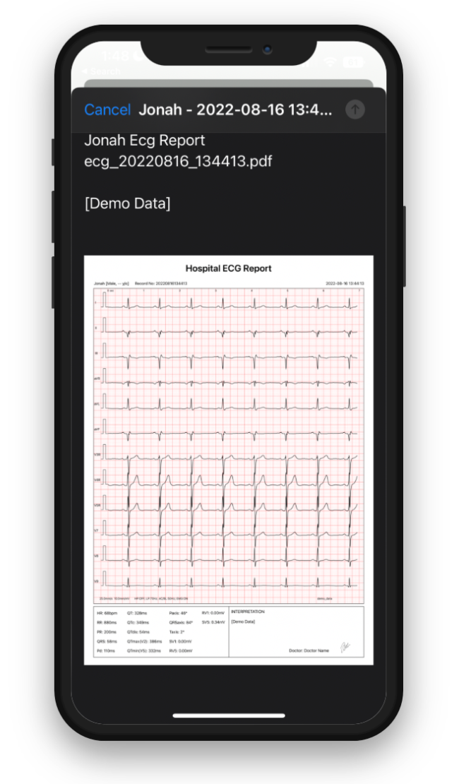 VH ECG on Phone