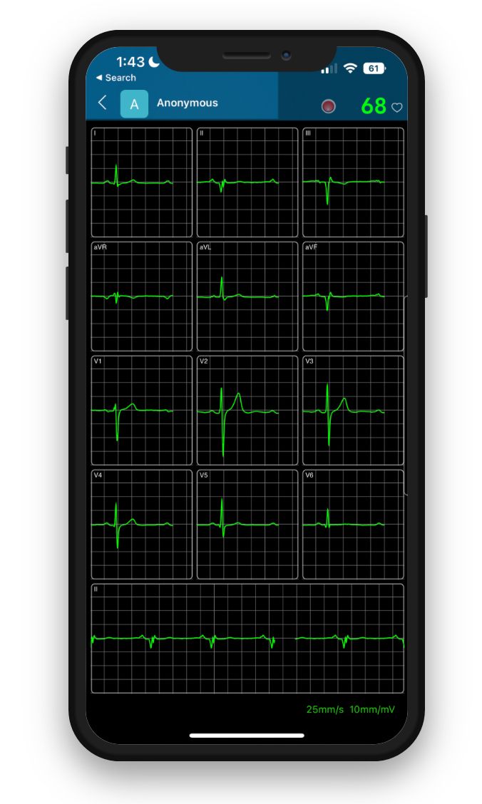 VH ECG on Phone